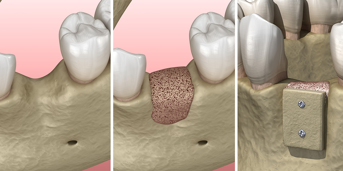 Bone Grafting